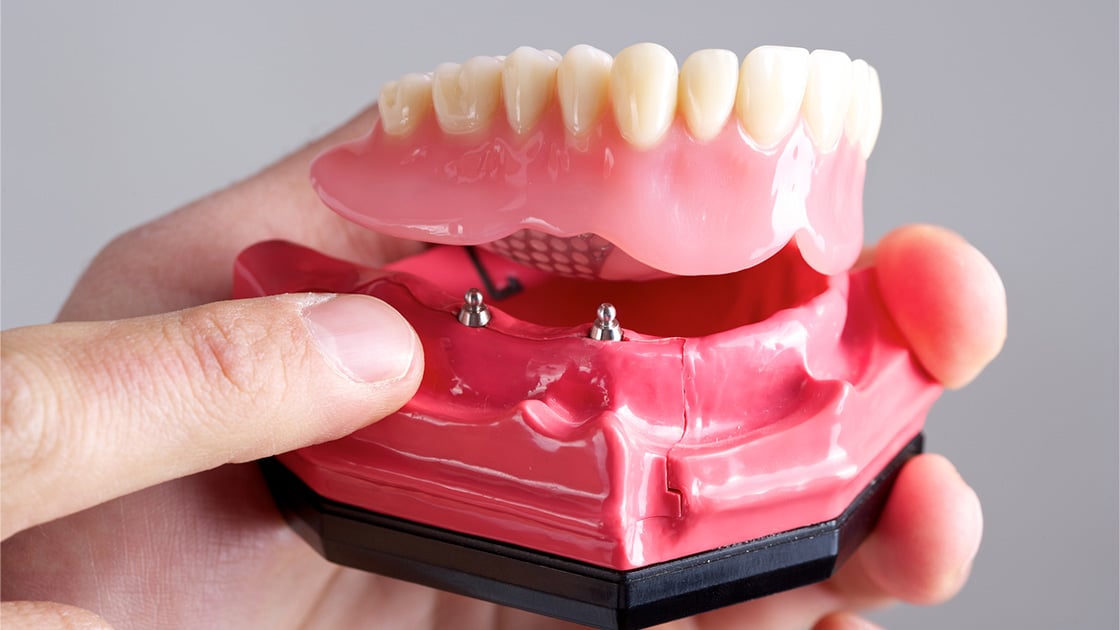 Fixed-Hybrid-Dentures